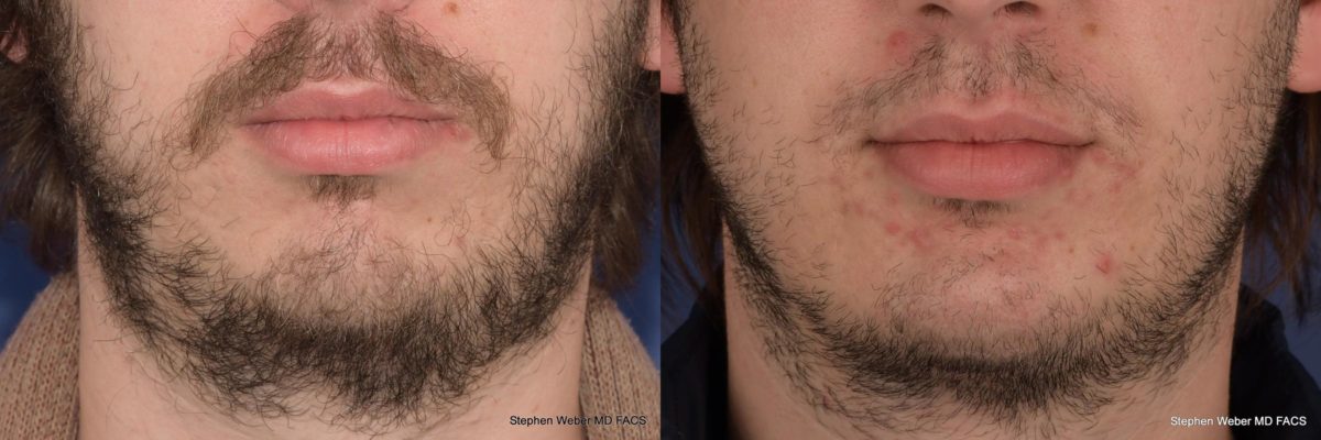 Chin Implant Before and After | Weber Facial Plastic Surgery
