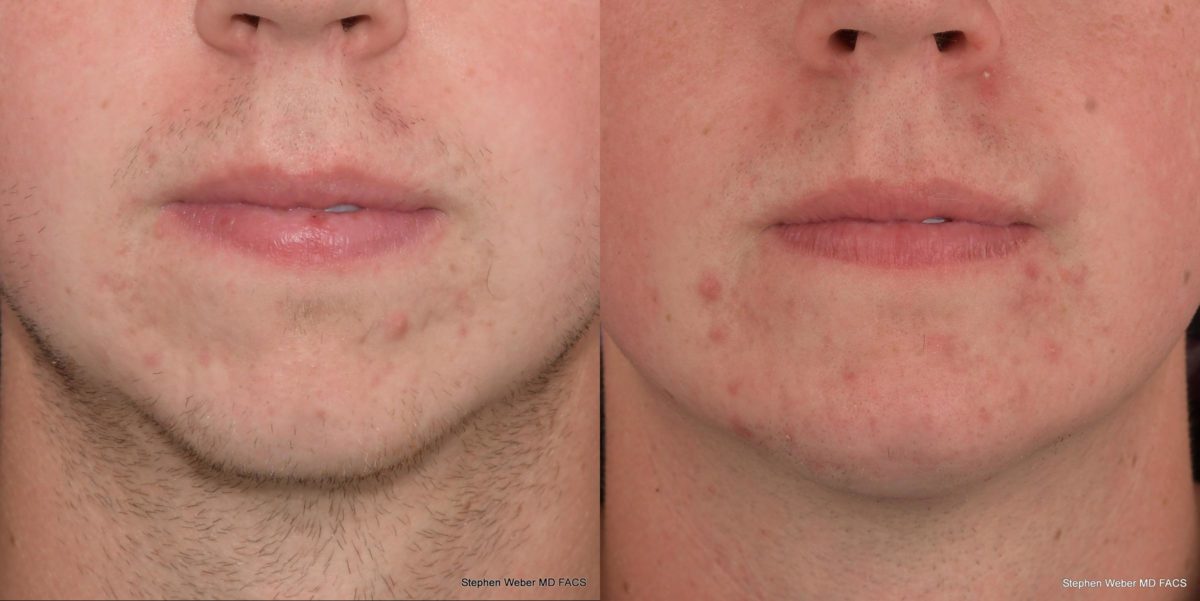 Chin Implant Before and After | Weber Facial Plastic Surgery
