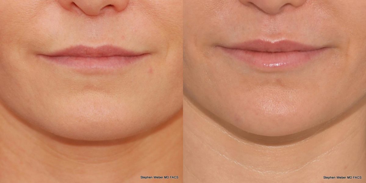 Chin Implant Before and After | Weber Facial Plastic Surgery