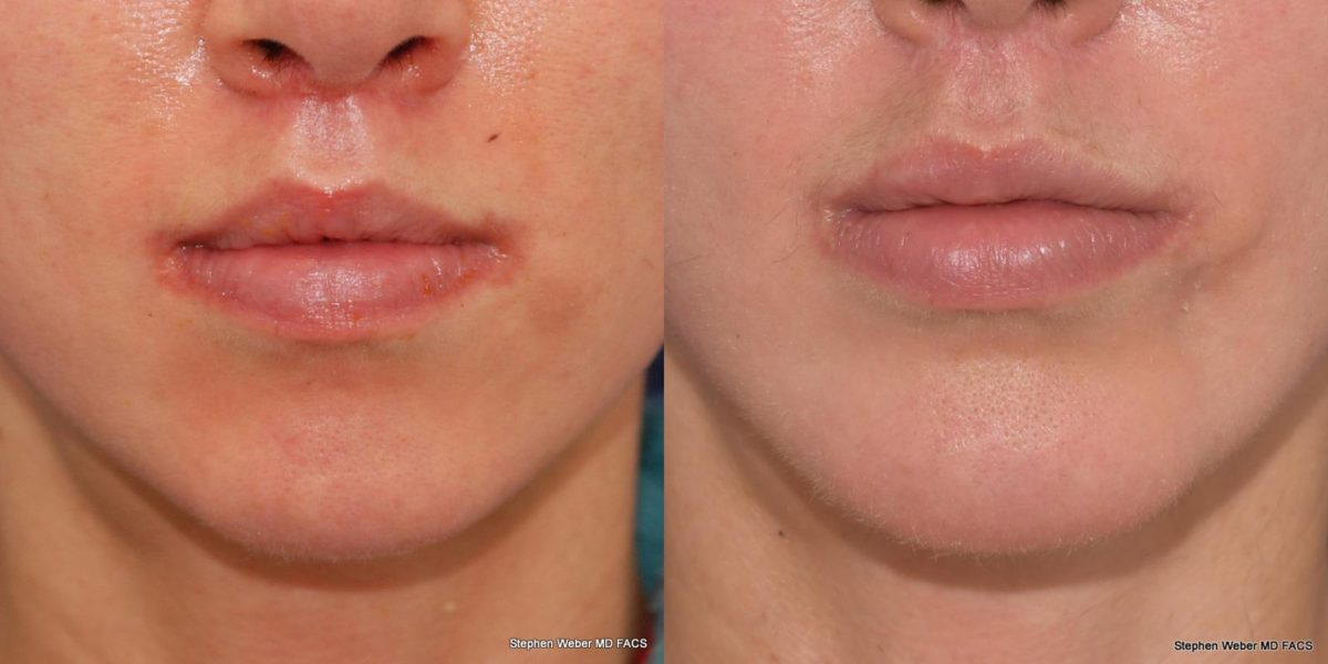 Chin Implant Before and After | Weber Facial Plastic Surgery