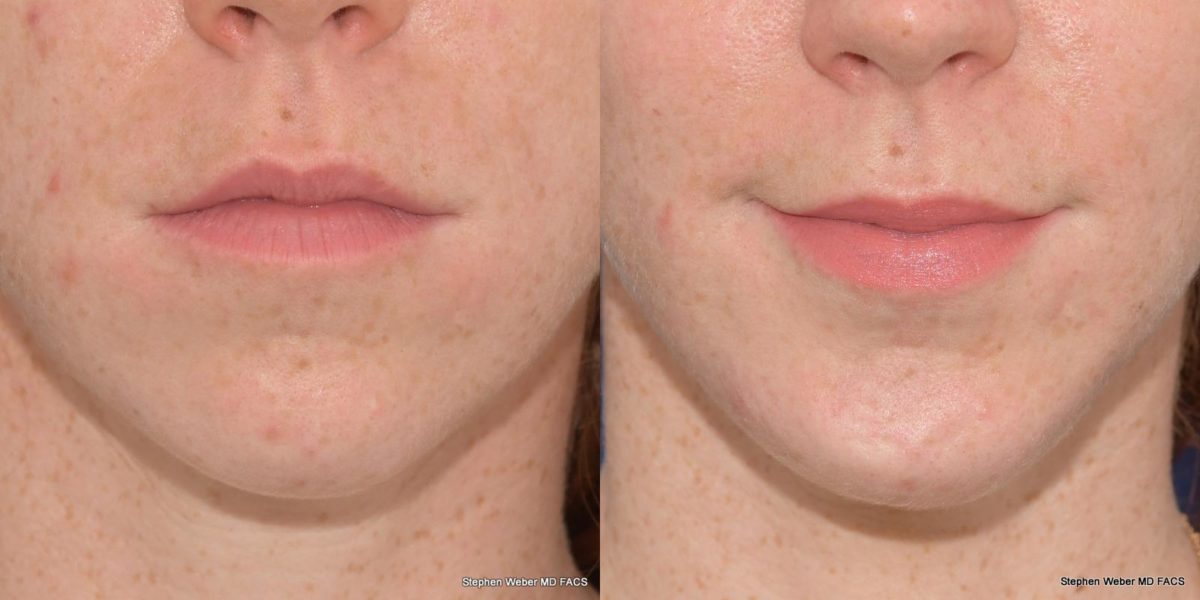 Chin Implant Before and After | Weber Facial Plastic Surgery