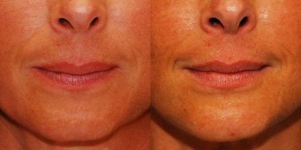 Chin Implant Before and After | Weber Facial Plastic Surgery