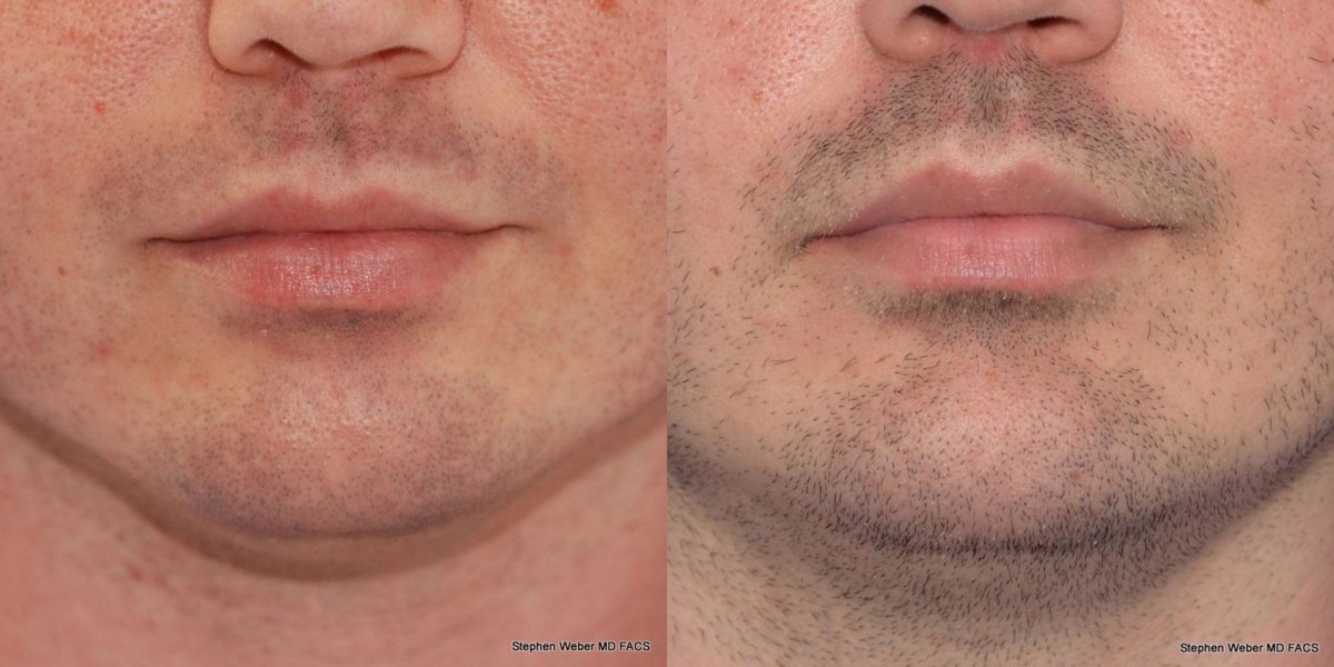 Chin Implant Before and After | Weber Facial Plastic Surgery