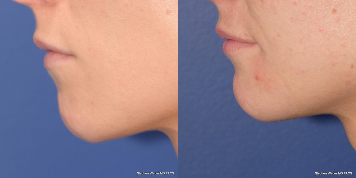Chin Implant Before and After | Weber Facial Plastic Surgery