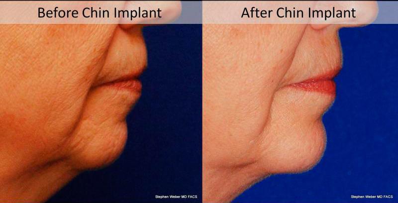 Chin Implant Before and After | Weber Facial Plastic Surgery