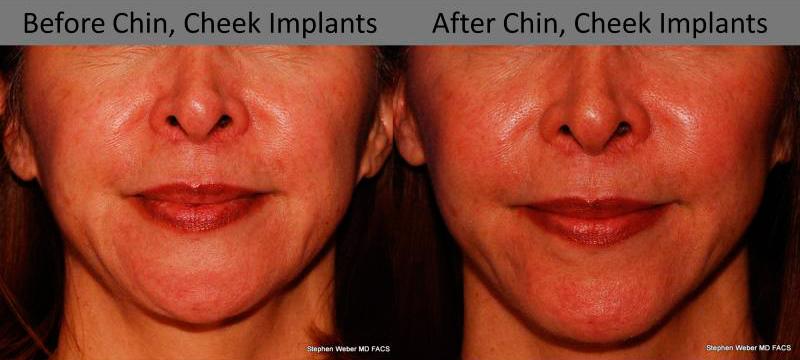 Chin Implant Before and After | Weber Facial Plastic Surgery
