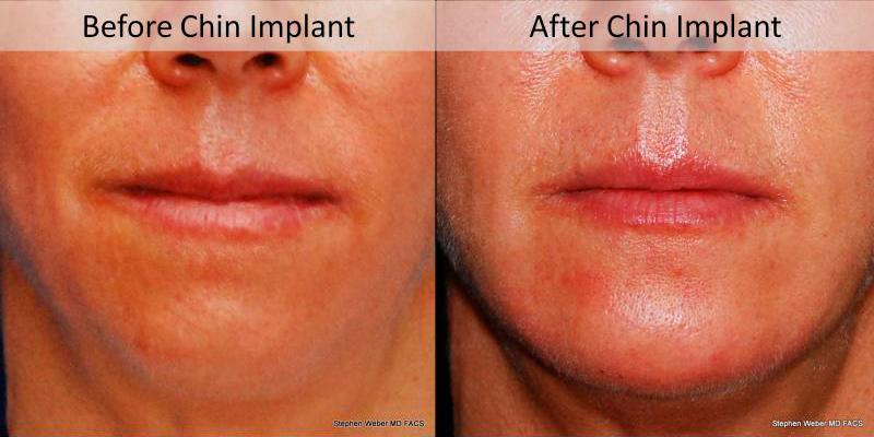 Chin Implant Before and After | Weber Facial Plastic Surgery