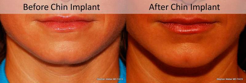 Chin Implant Before and After | Weber Facial Plastic Surgery