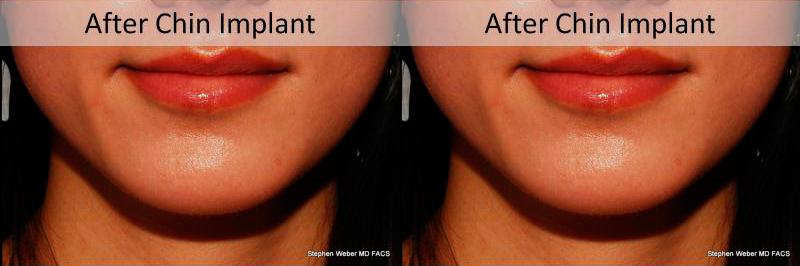 Chin Implant Before and After | Weber Facial Plastic Surgery