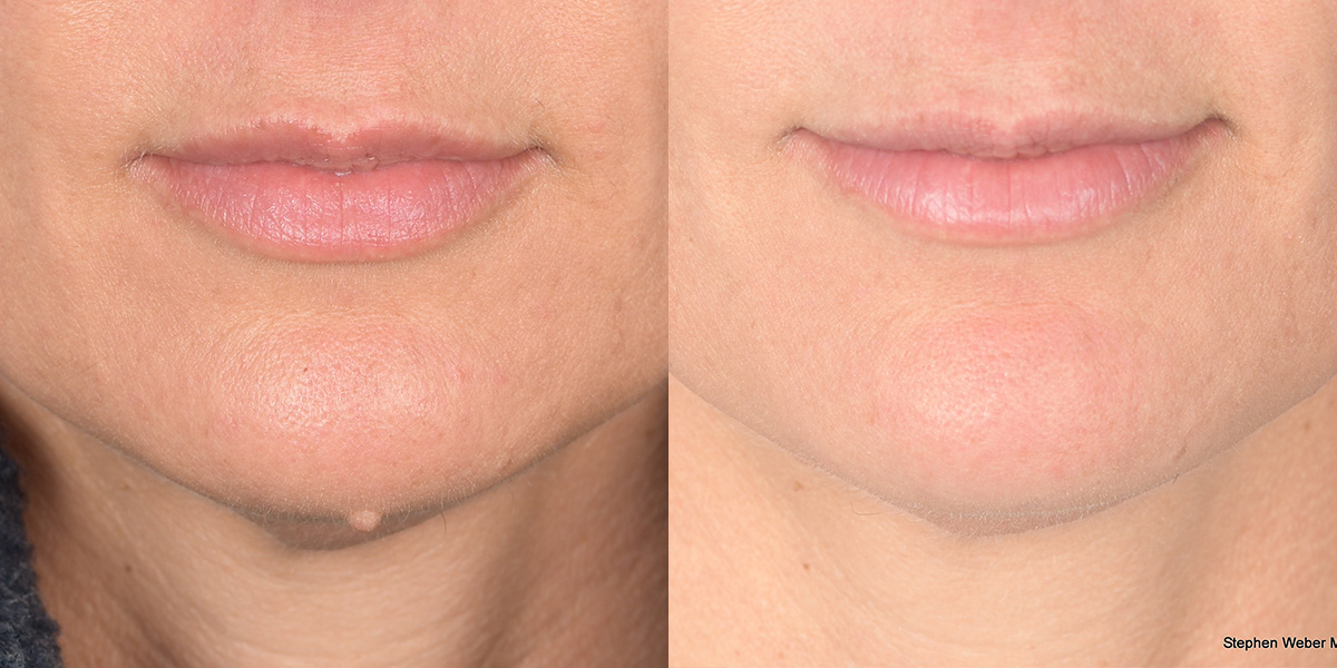 Cosmetic Excision Before and After | Weber Facial Plastic Surgery