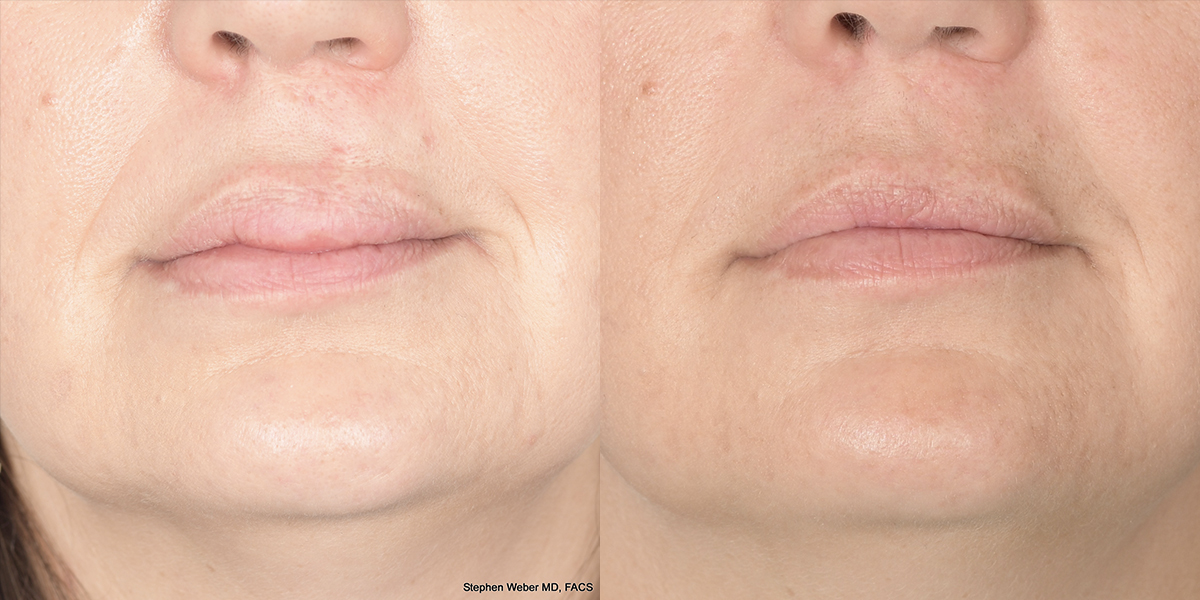 Cosmetic Excision Before and After | Weber Facial Plastic Surgery