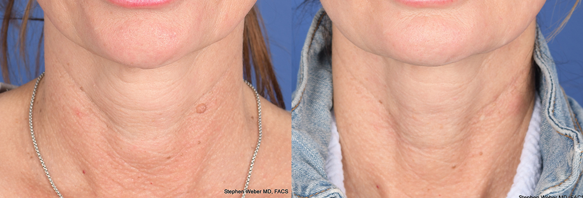 Cosmetic Excision Before and After | Weber Facial Plastic Surgery