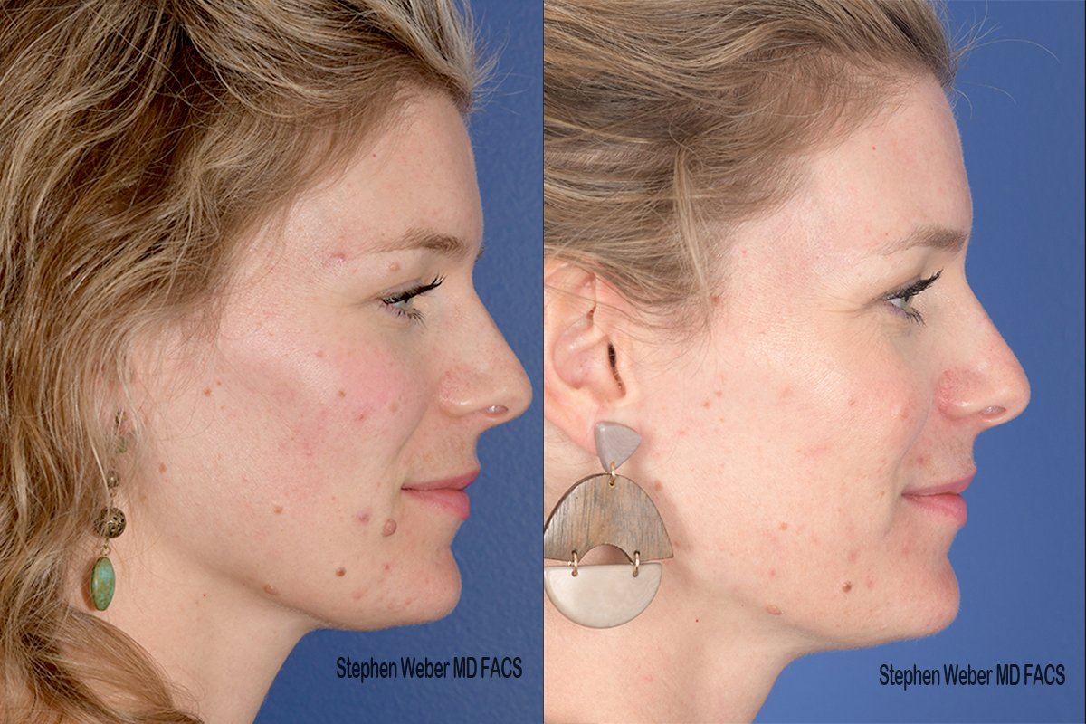 Cosmetic Excision Before and After | Weber Facial Plastic Surgery