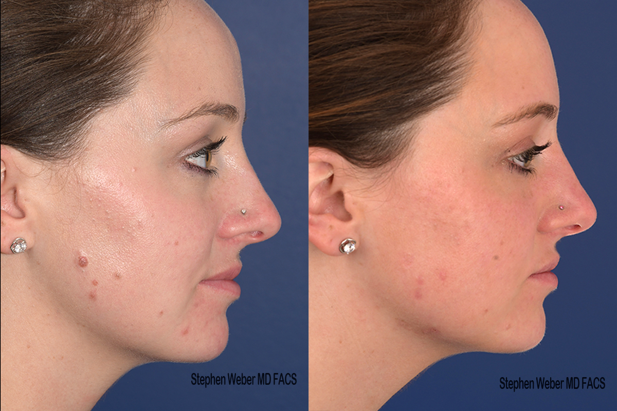 Cosmetic Excision Before and After | Weber Facial Plastic Surgery