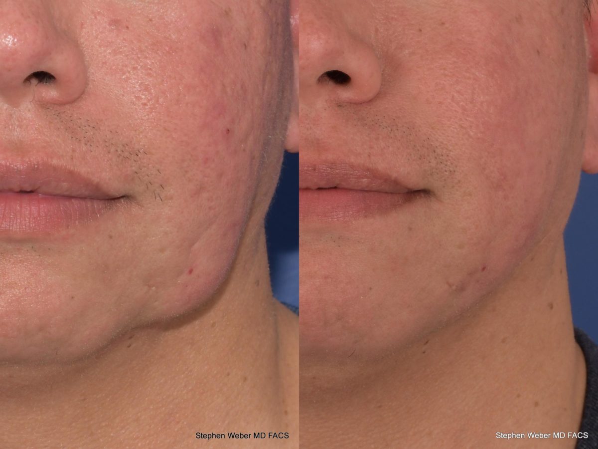 Cosmetic Excision Before and After | Weber Facial Plastic Surgery