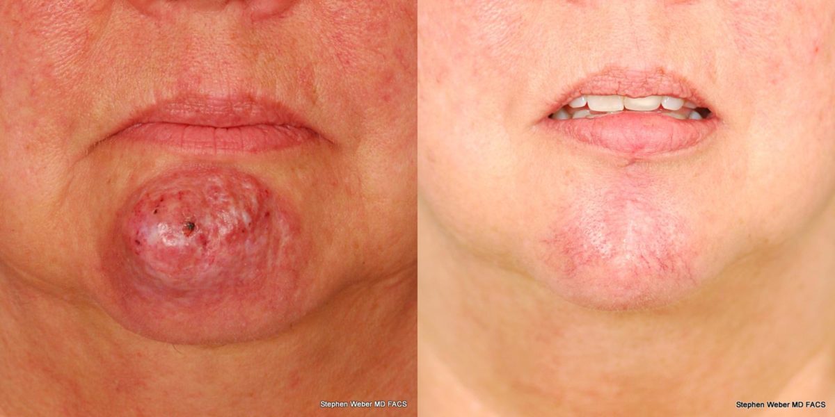 Cosmetic Excision Before and After | Weber Facial Plastic Surgery