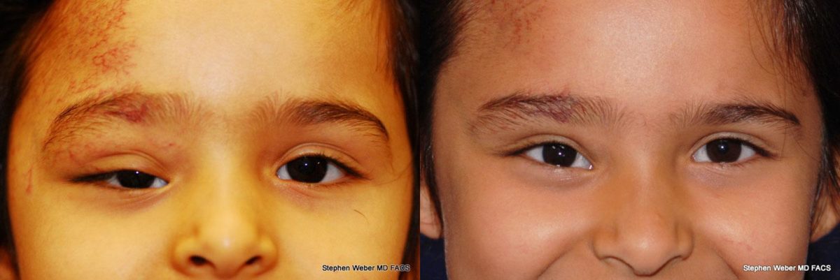 Cosmetic Excision Before and After | Weber Facial Plastic Surgery