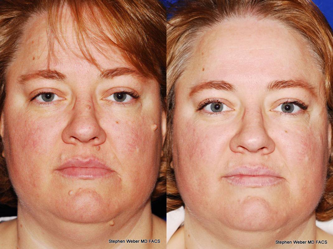 Cosmetic Excision Before and After | Weber Facial Plastic Surgery