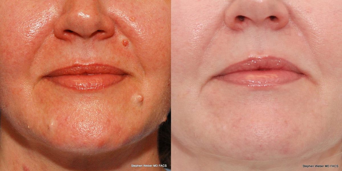 Cosmetic Excision Before and After | Weber Facial Plastic Surgery