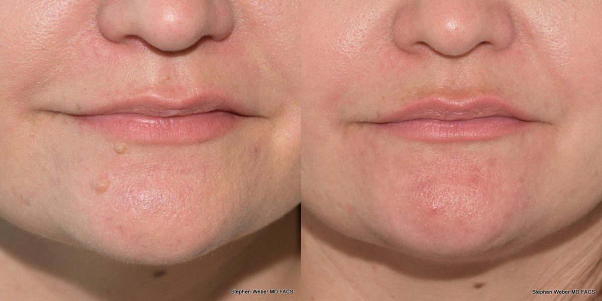 Cosmetic Excision Before and After | Weber Facial Plastic Surgery