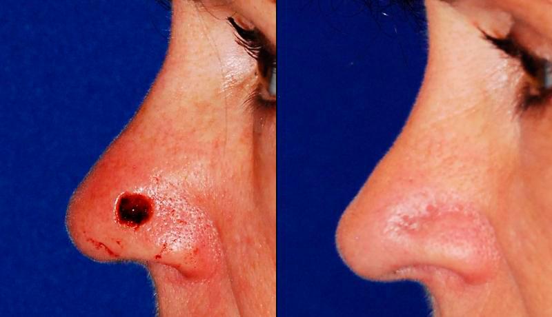 Cosmetic Excision Before and After | Weber Facial Plastic Surgery