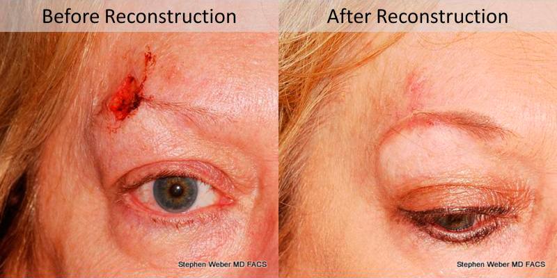 Cosmetic Excision Before and After | Weber Facial Plastic Surgery