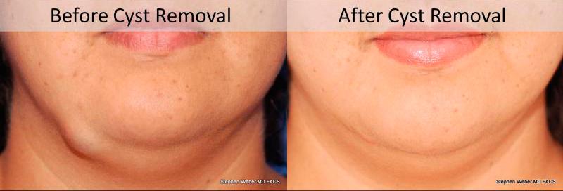 Cosmetic Excision Before and After | Weber Facial Plastic Surgery