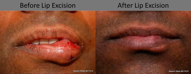 Cosmetic Excision Before and After | Weber Facial Plastic Surgery
