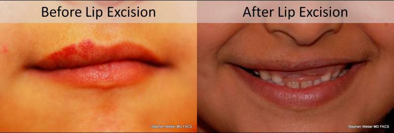 Cosmetic Excision Before and After | Weber Facial Plastic Surgery