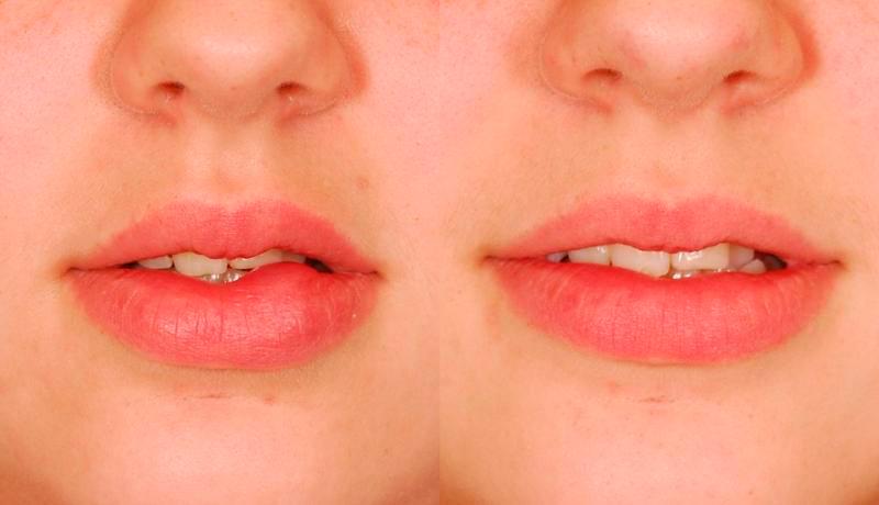 Cosmetic Excision Before and After | Weber Facial Plastic Surgery