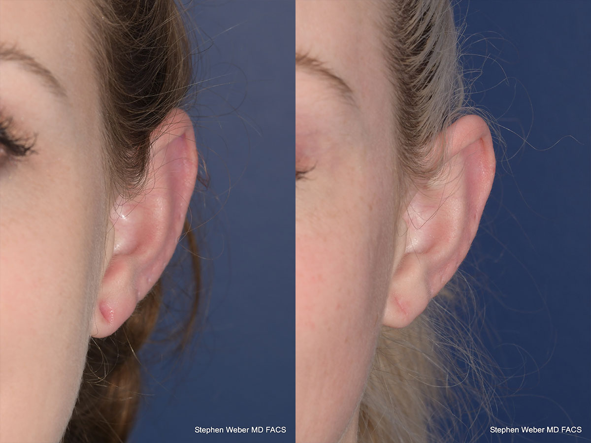 Earlobe Repair Before and After | Weber Facial Plastic Surgery