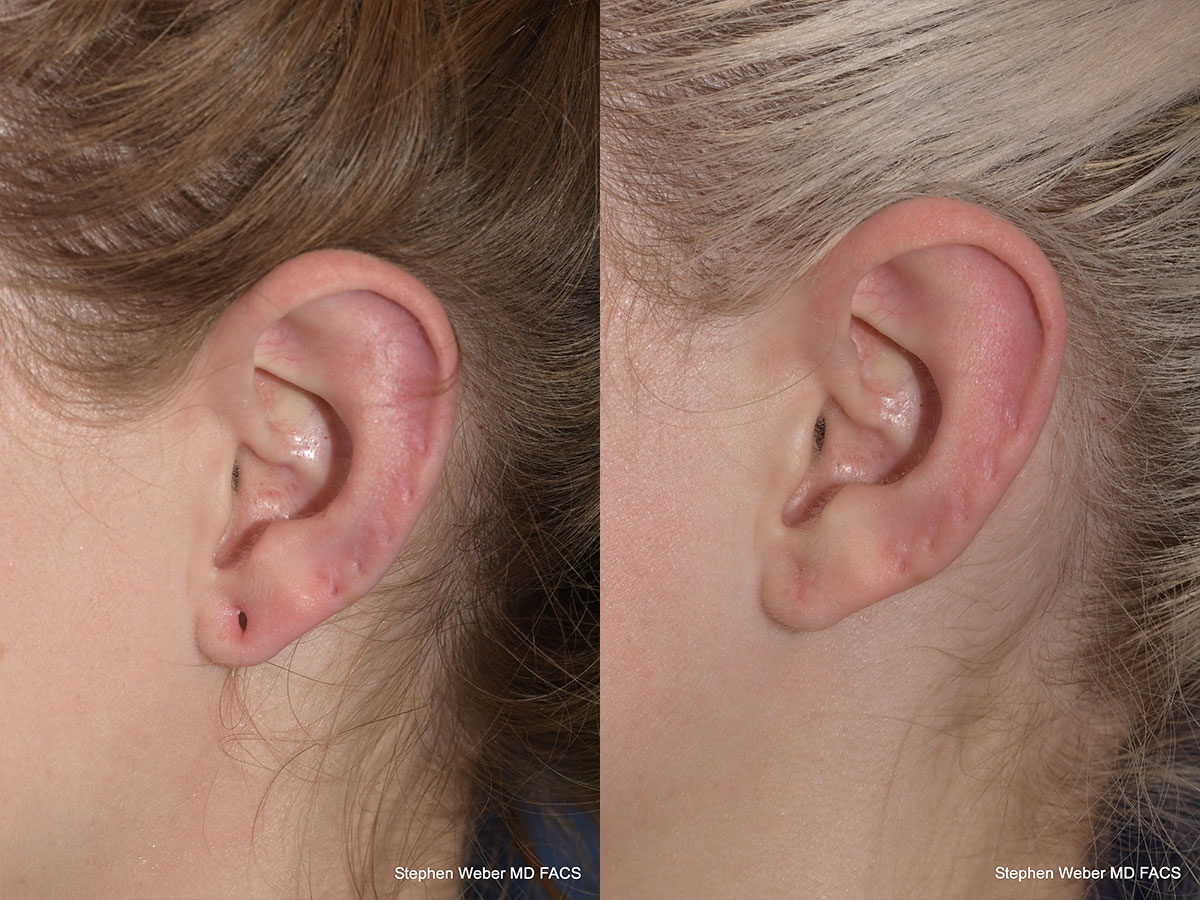 Earlobe Repair Before and After | Weber Facial Plastic Surgery