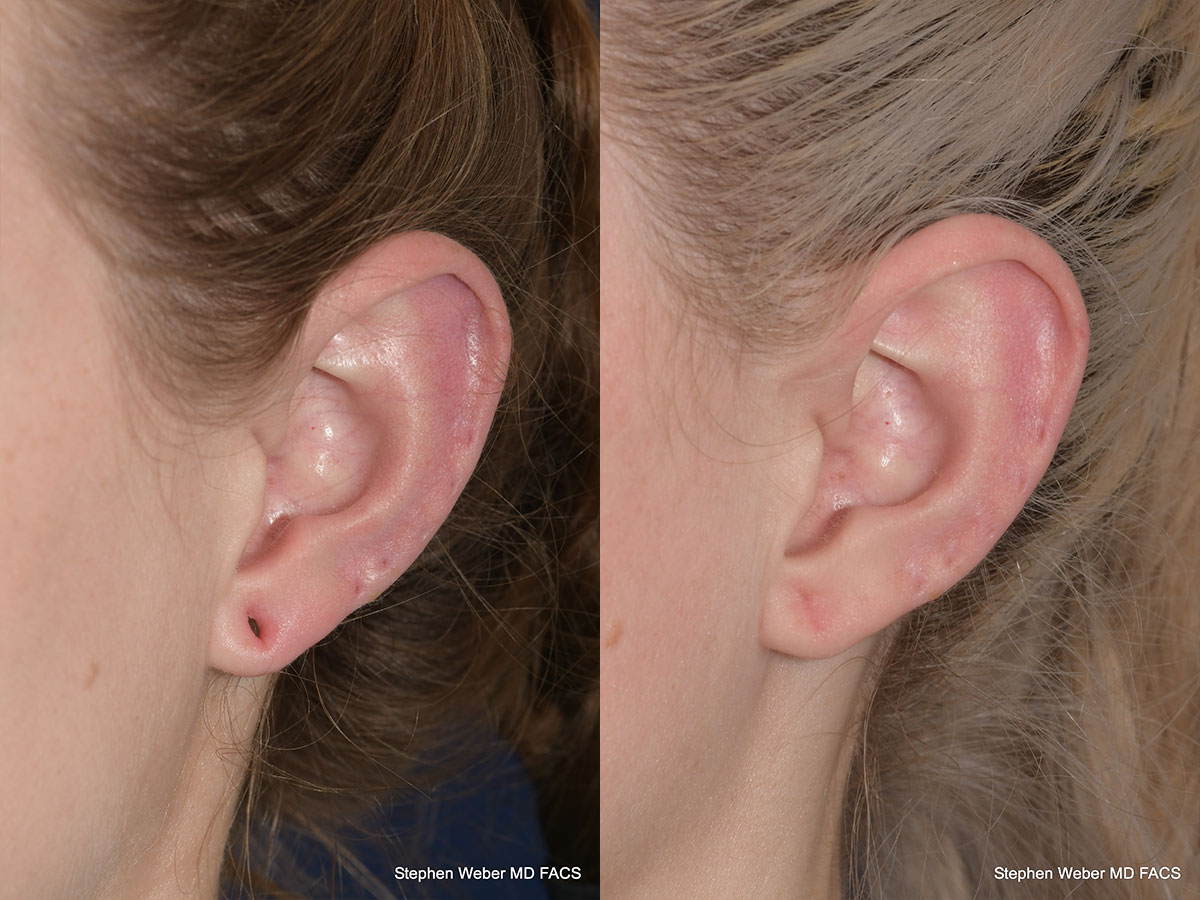 Earlobe Repair Before and After | Weber Facial Plastic Surgery