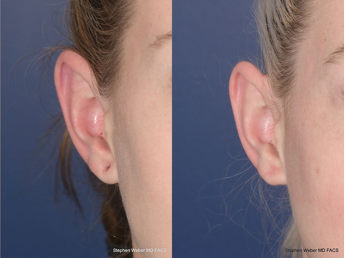 Earlobe Repair Before and After | Weber Facial Plastic Surgery
