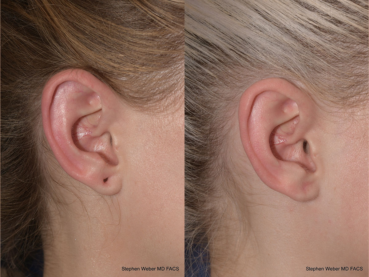 Earlobe Repair Before and After | Weber Facial Plastic Surgery