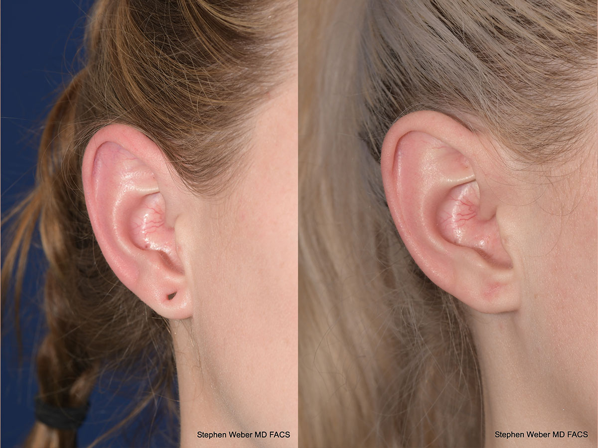Earlobe Repair Before and After | Weber Facial Plastic Surgery