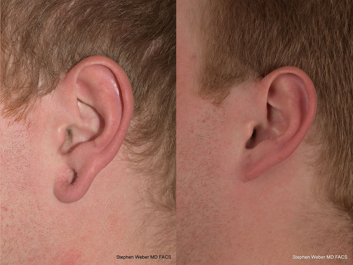 Earlobe Repair Before and After | Weber Facial Plastic Surgery