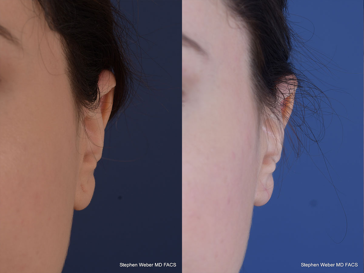 Earlobe Repair Before and After | Weber Facial Plastic Surgery