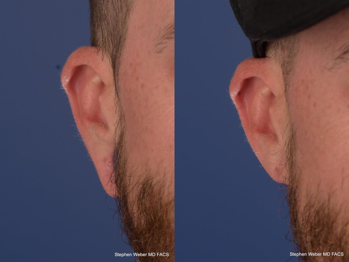 Earlobe Repair Before and After | Weber Facial Plastic Surgery