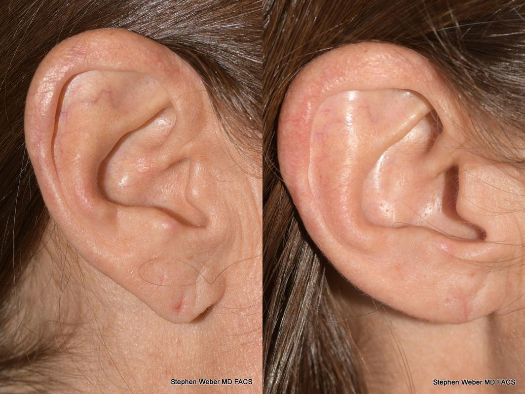 Earlobe Repair Before and After | Weber Facial Plastic Surgery