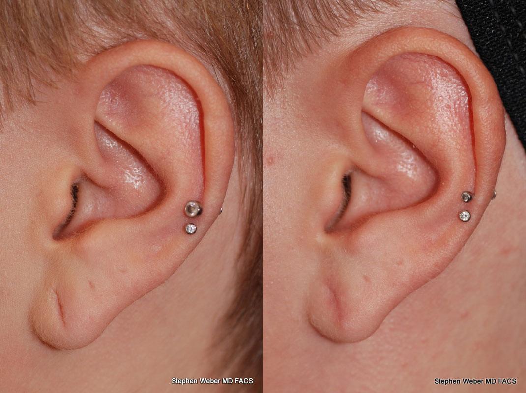 Earlobe Repair Before and After | Weber Facial Plastic Surgery