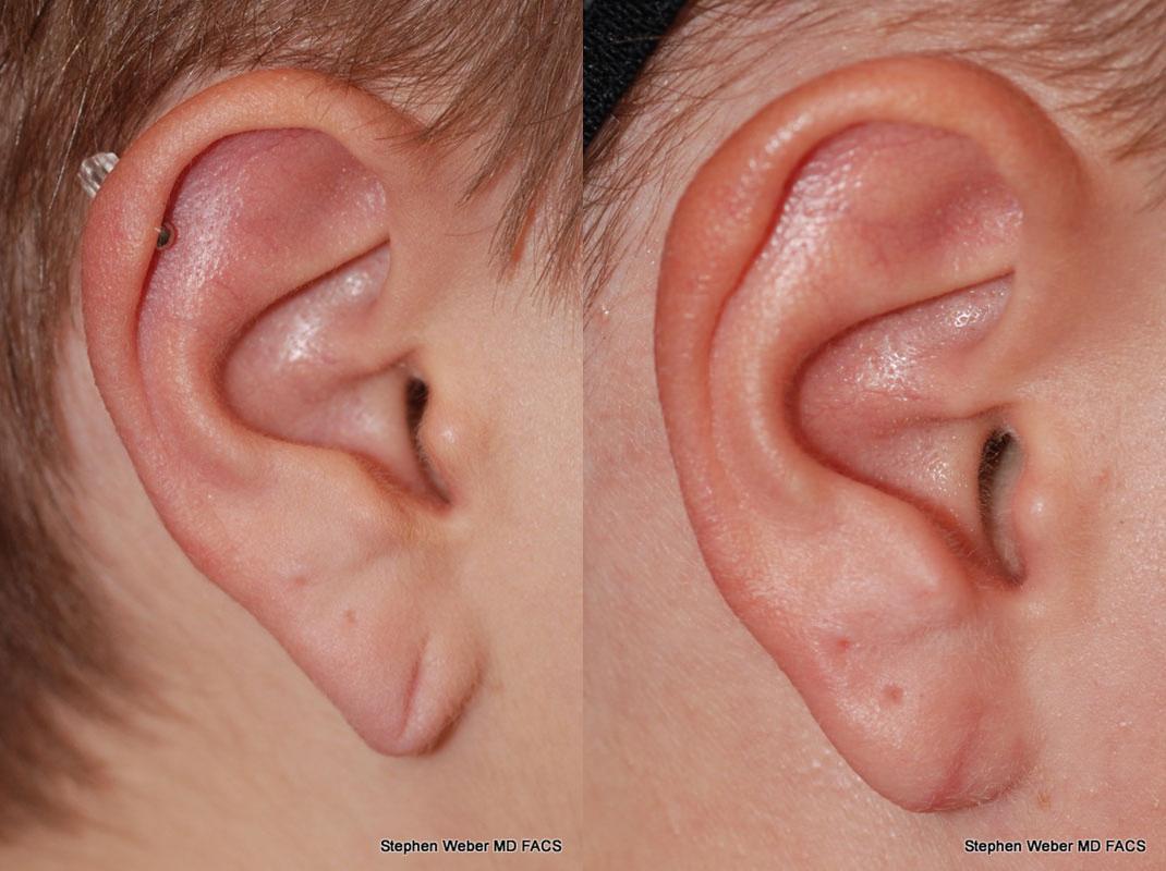 Earlobe Repair Before and After | Weber Facial Plastic Surgery