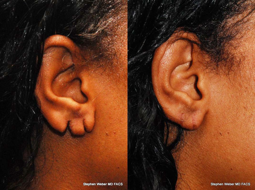Earlobe Repair Before and After | Weber Facial Plastic Surgery
