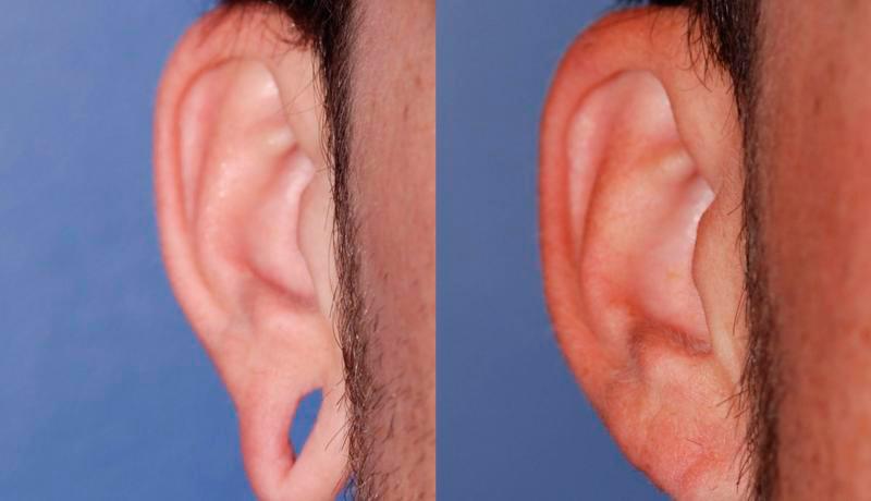 Earlobe Repair Before and After | Weber Facial Plastic Surgery