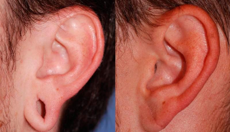 Earlobe Repair Before and After | Weber Facial Plastic Surgery