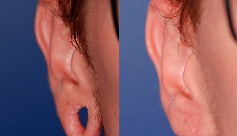 Earlobe Repair Before and After | Weber Facial Plastic Surgery