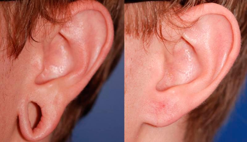 Earlobe Repair Before and After | Weber Facial Plastic Surgery