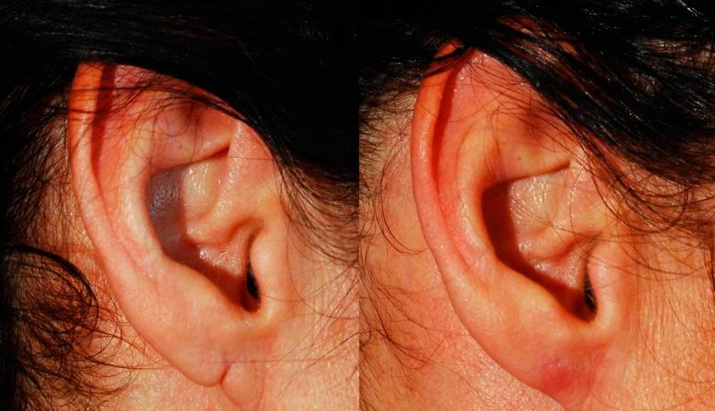 Earlobe Repair Before and After | Weber Facial Plastic Surgery