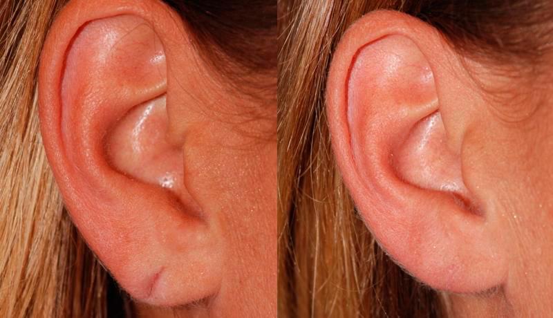 Earlobe Repair Before and After | Weber Facial Plastic Surgery