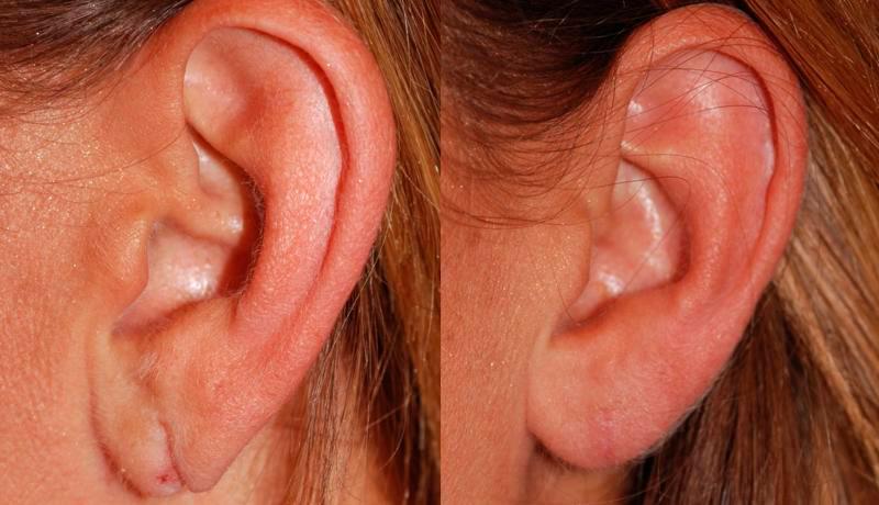 Earlobe Repair Before and After | Weber Facial Plastic Surgery